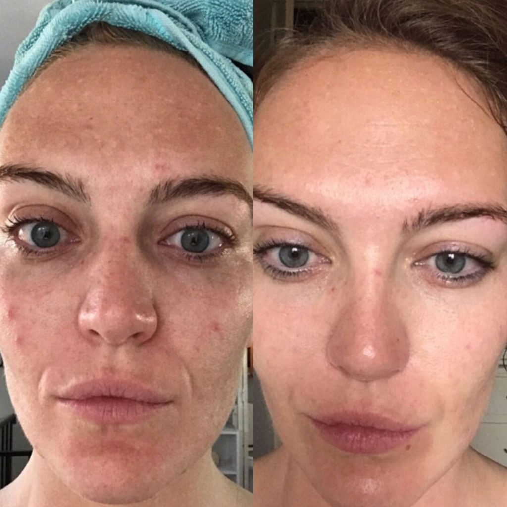 microneedling before and after wrinkles forehead 1024x1024